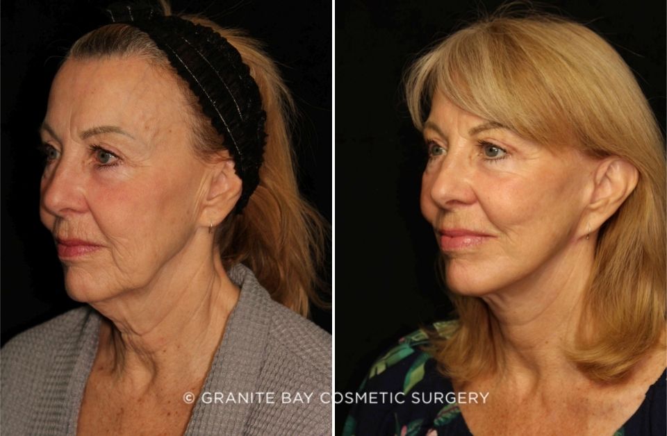 Case # 1 after photo