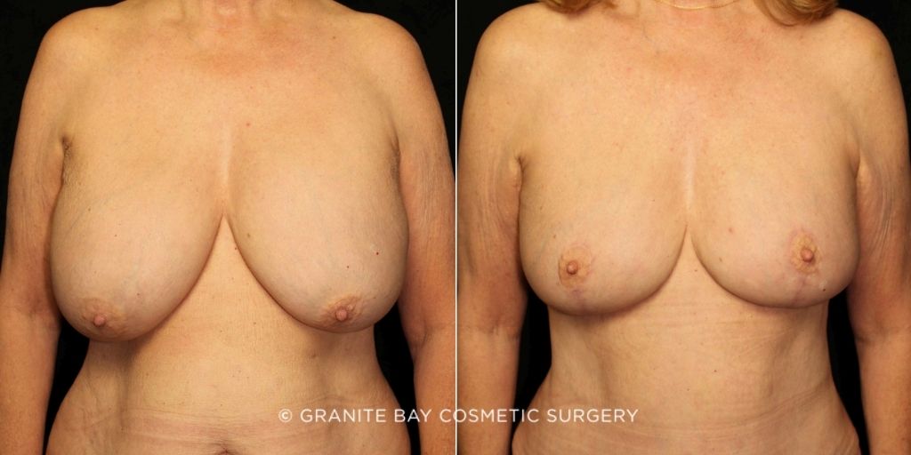 Case # 1 after photo