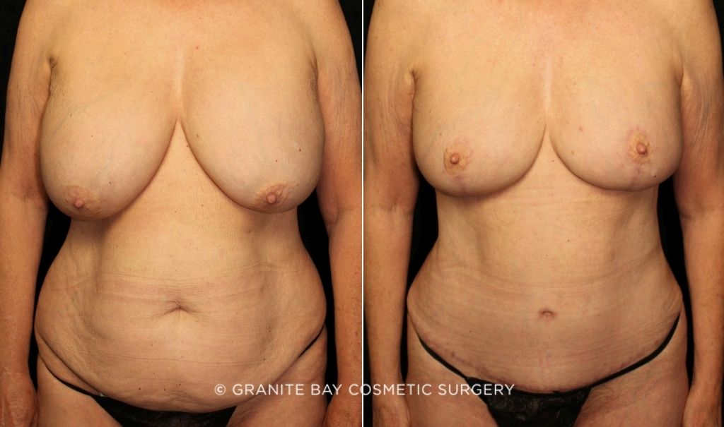 Case # 2 after photo