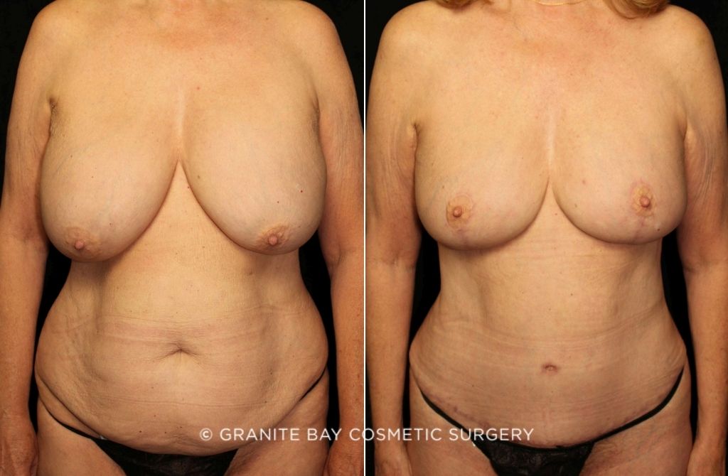 Case # 2 after photo