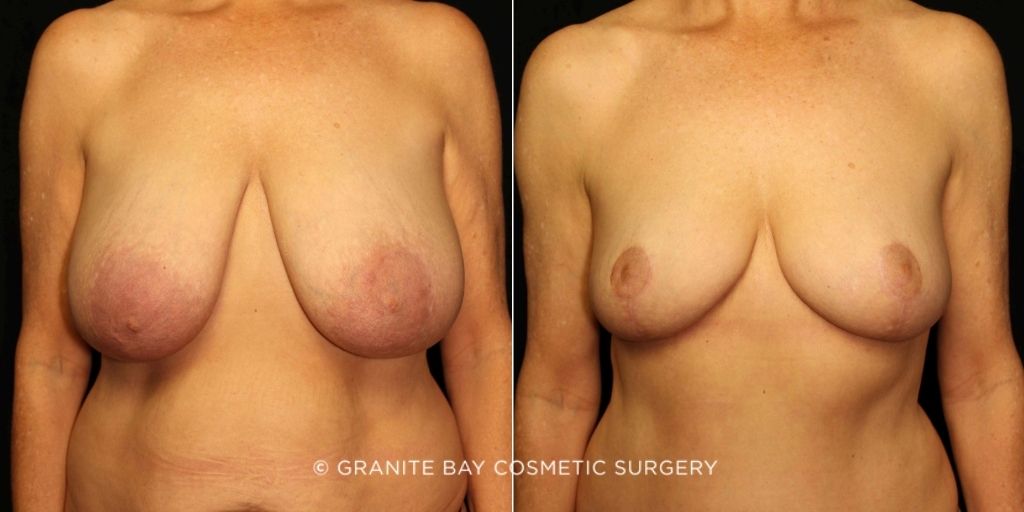 Case # 2 after photo