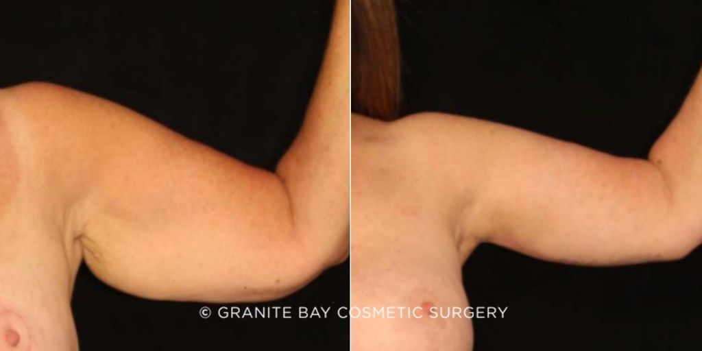 Case # 1 after photo