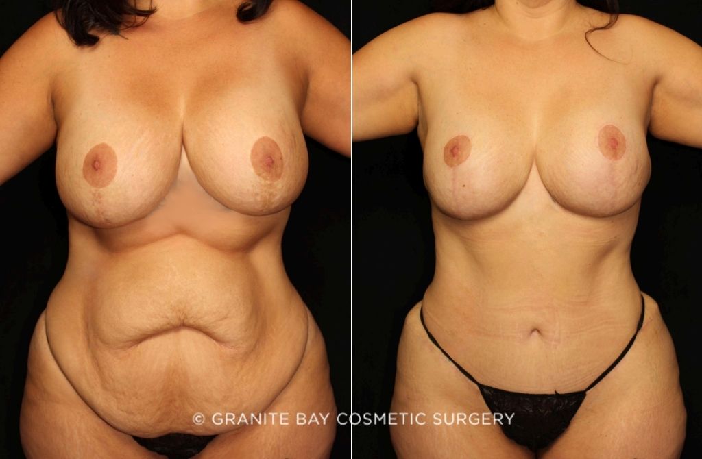 Case # 4 after photo