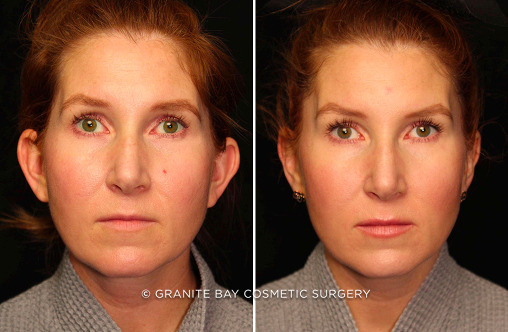 Case # 1 after photo