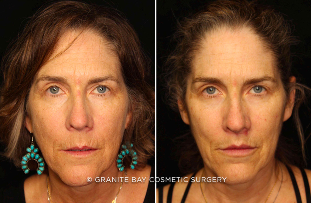 Case # 1 after photo