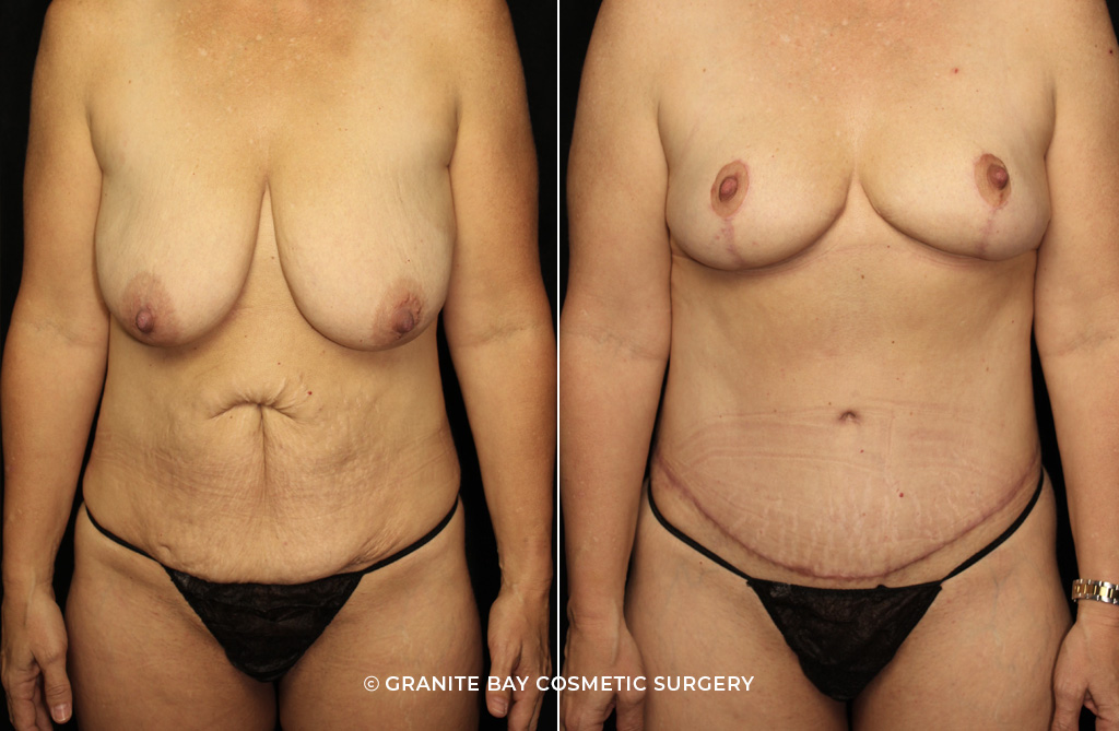 Case # 57 after photo