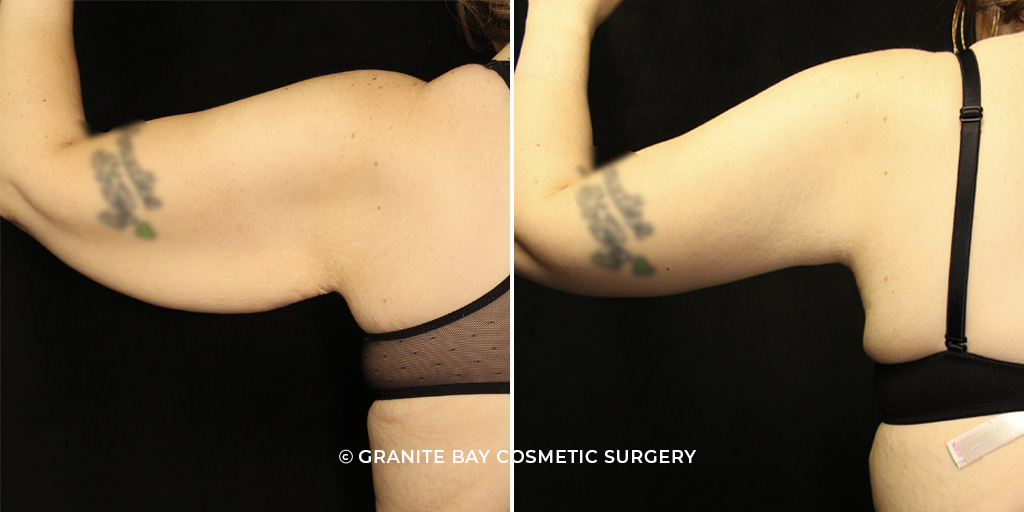 Case # 2 after photo