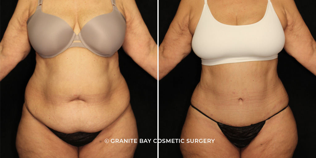 Case # 14 after photo