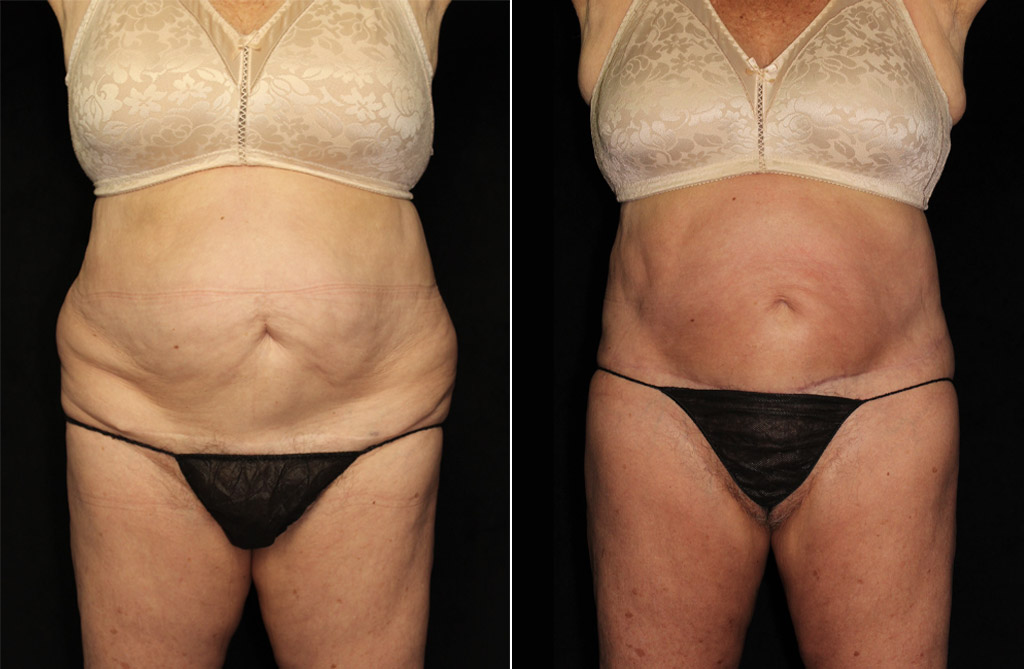 Case # 2 after photo