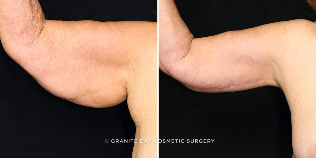 Case # 4 after photo