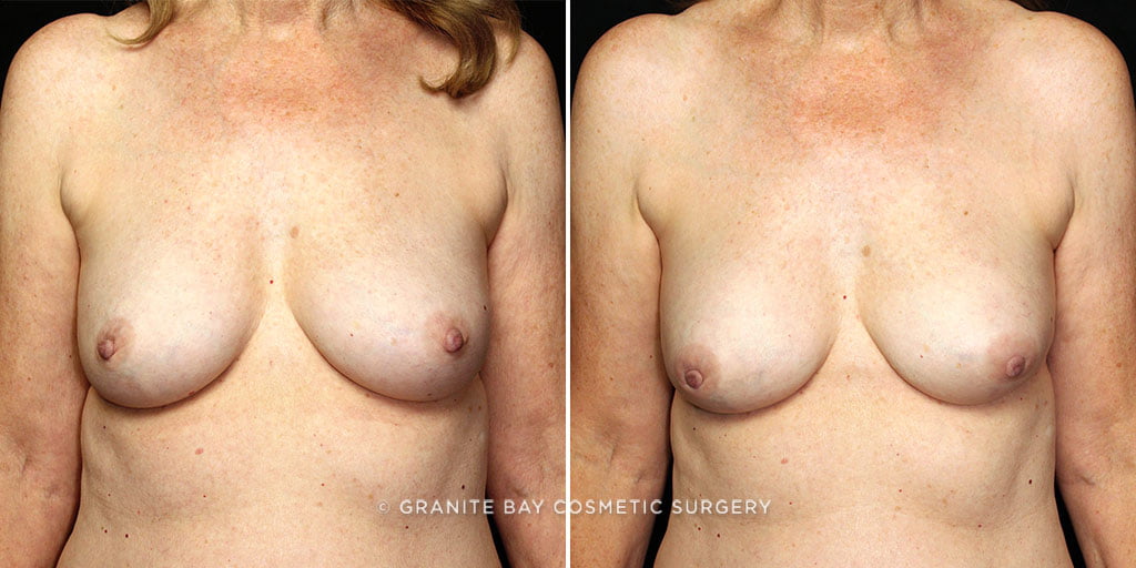 Case # 2 after photo