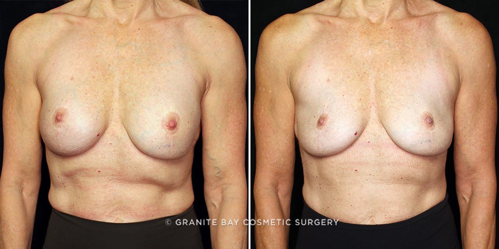 Case # 4 after photo