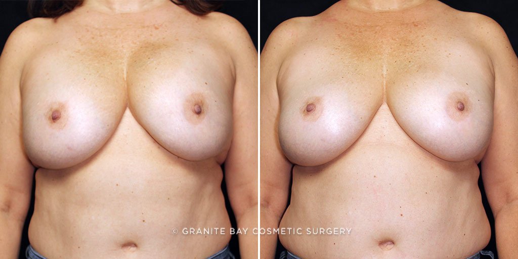 Case # 2 after photo