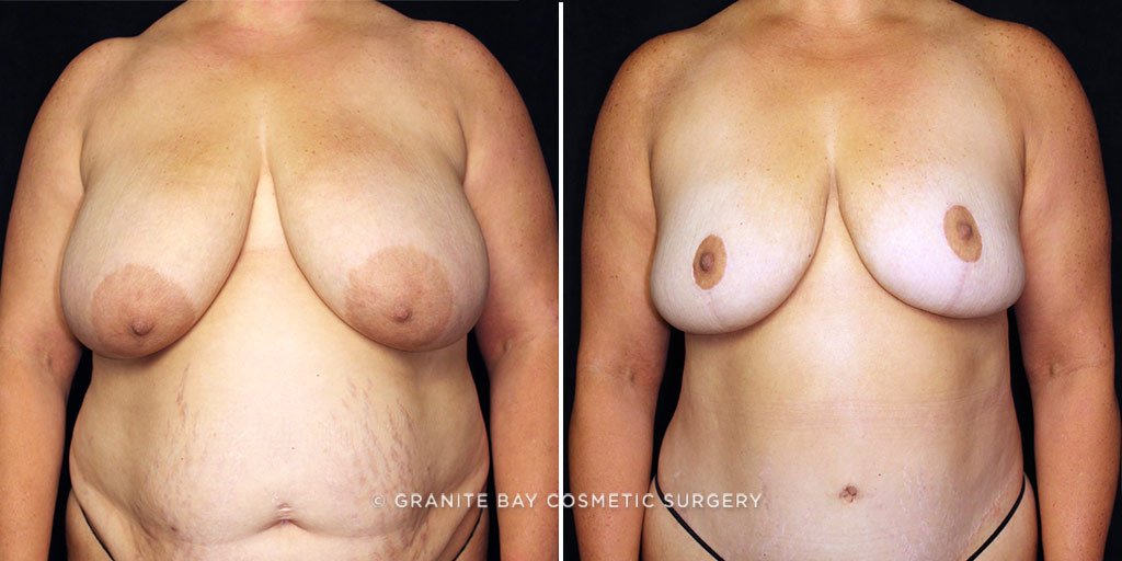 Case # 11 after photo