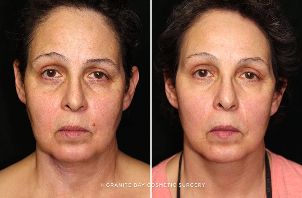 Case # 2 after photo