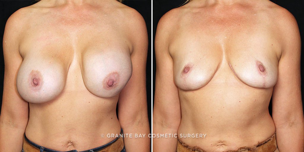 Case # 11 after photo