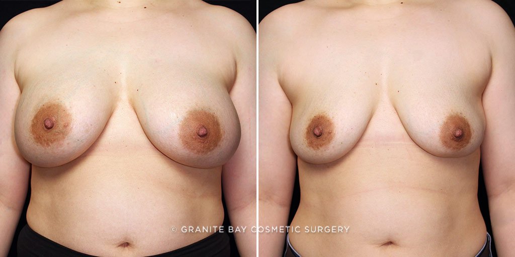 Case # 14 after photo