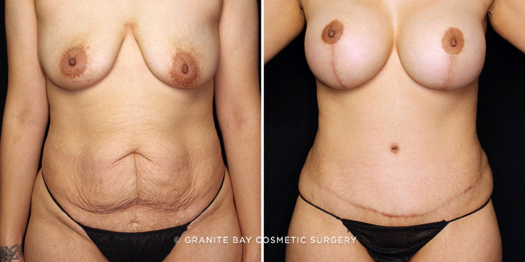 Case # 35 after photo