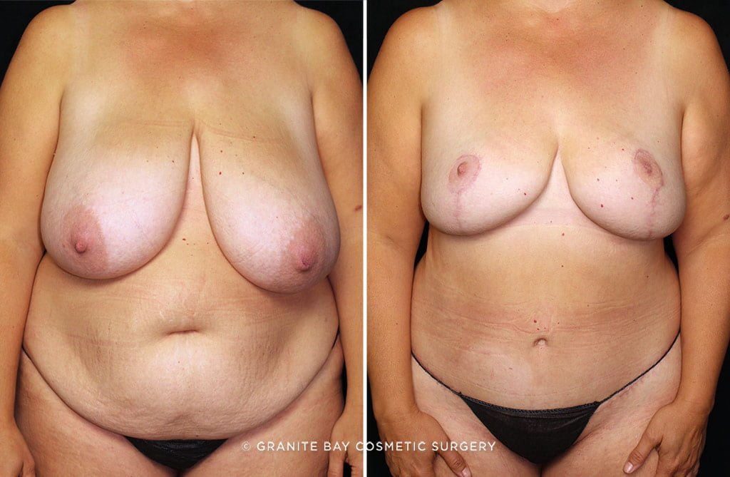 Case # 23 after photo