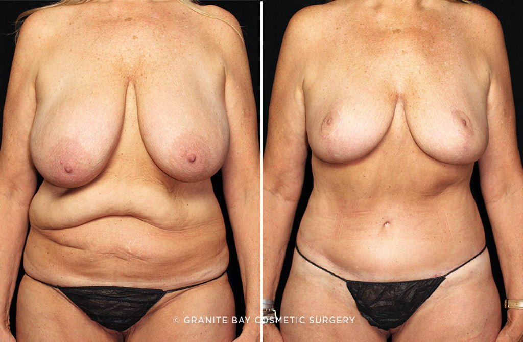 Case # 25 after photo