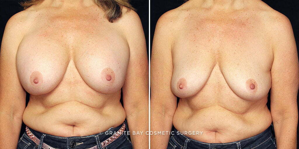 Case # 17 after photo