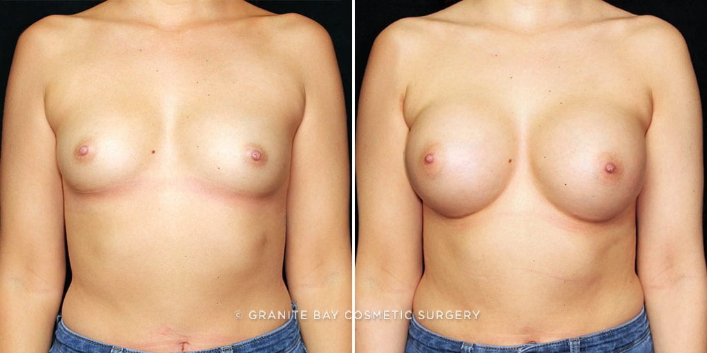 Case # 33 after photo