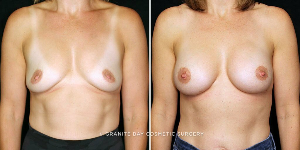 Case # 44 after photo