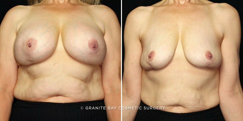 Case # 21 after photo