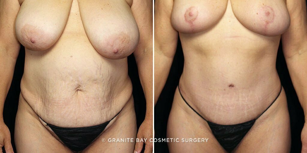 Case # 52 after photo