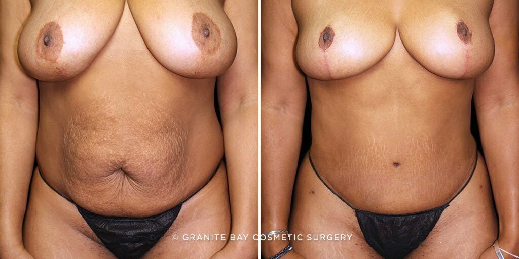 Case # 53 after photo