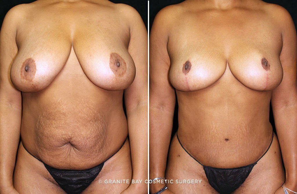 Case # 32 after photo