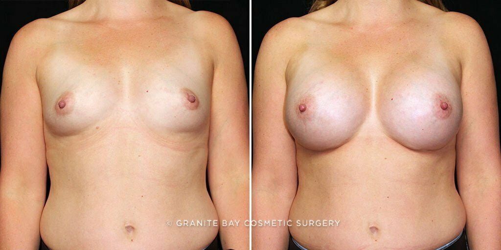 Case # 56 after photo