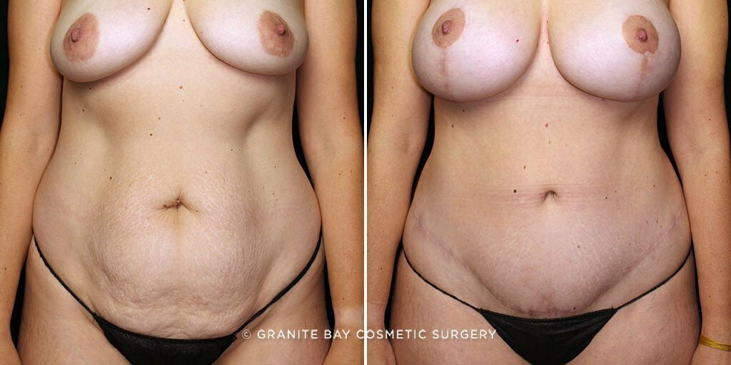 Case # 56 after photo