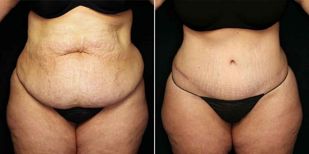 Case # 57 after photo