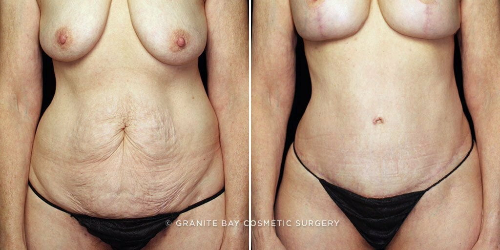 Case # 60 after photo