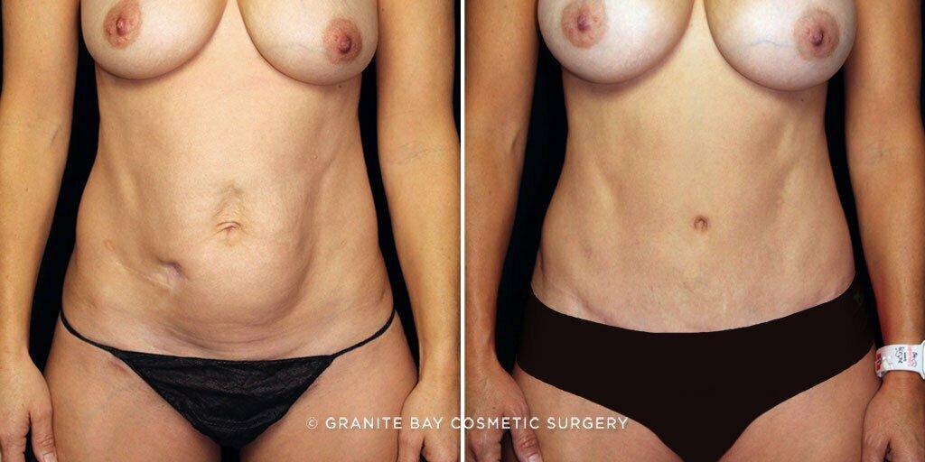 Case # 61 after photo