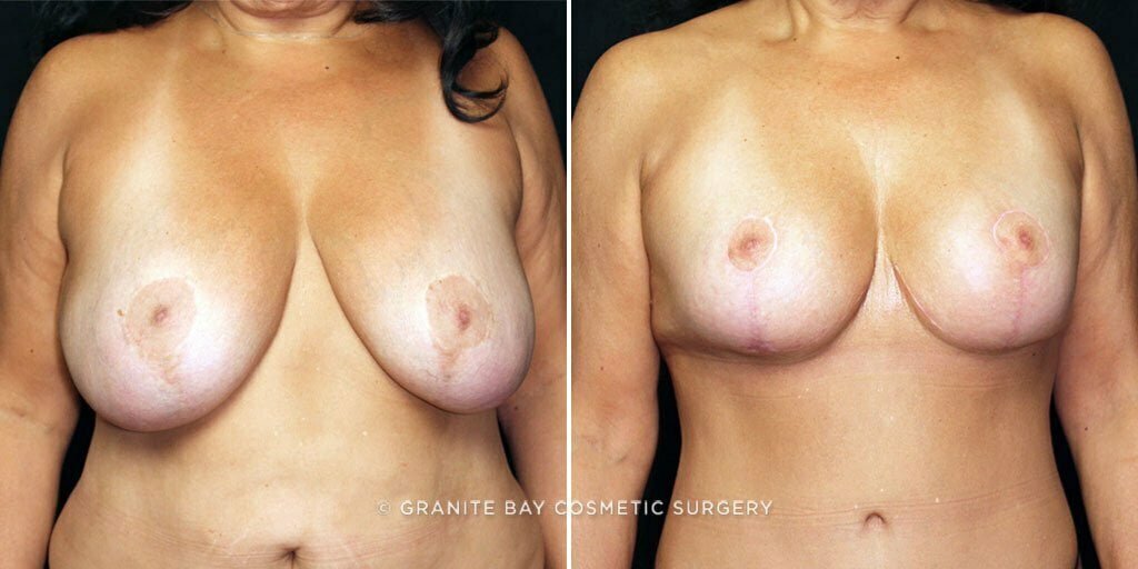 Case # 23 after photo