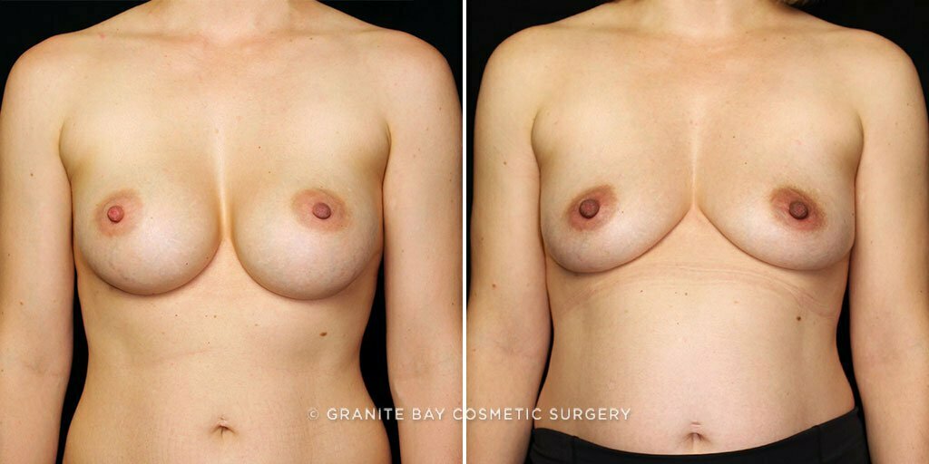 Case # 23 after photo