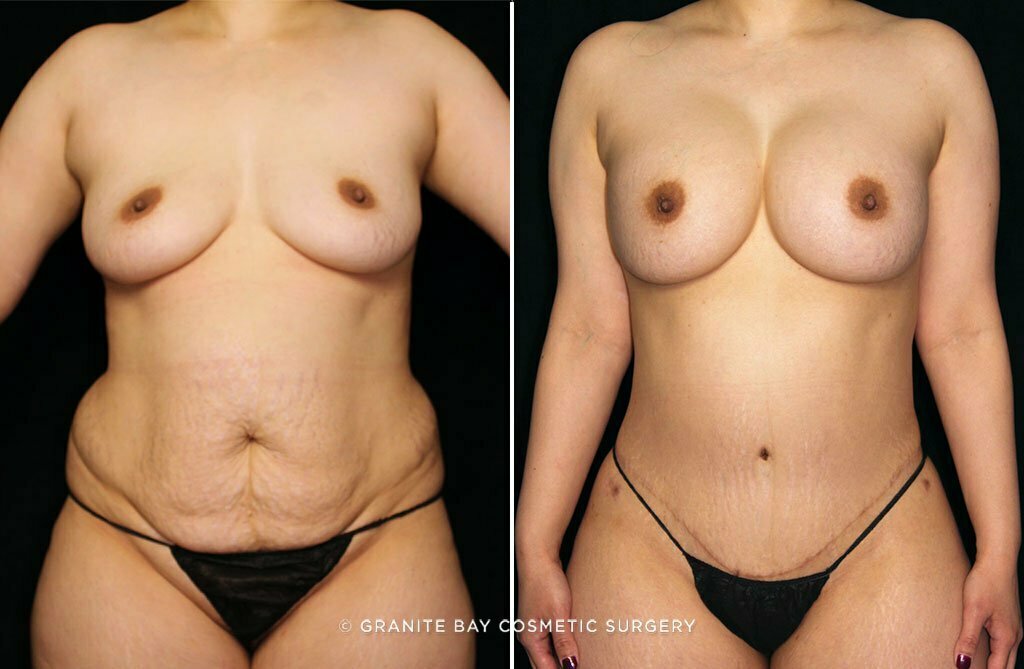 Case # 41 after photo