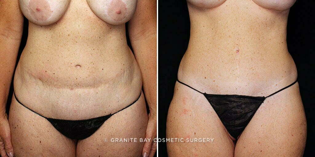 Case # 69 after photo