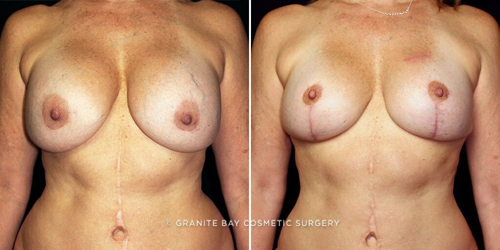 Case # 32 after photo