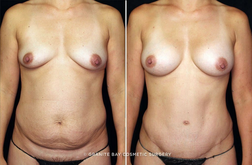 Case # 44 after photo