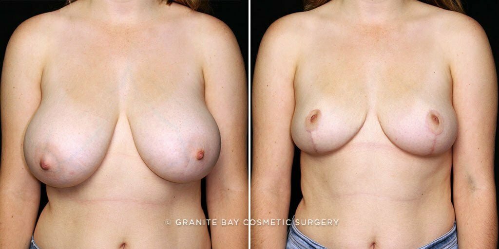 Case # 25 after photo