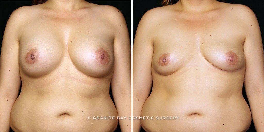 Case # 32 after photo