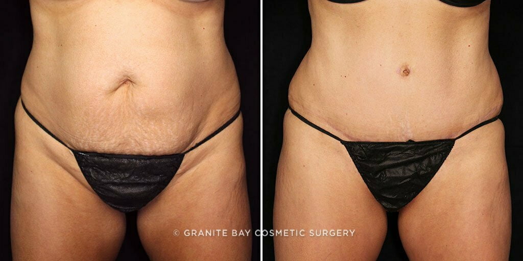 Case # 79 after photo