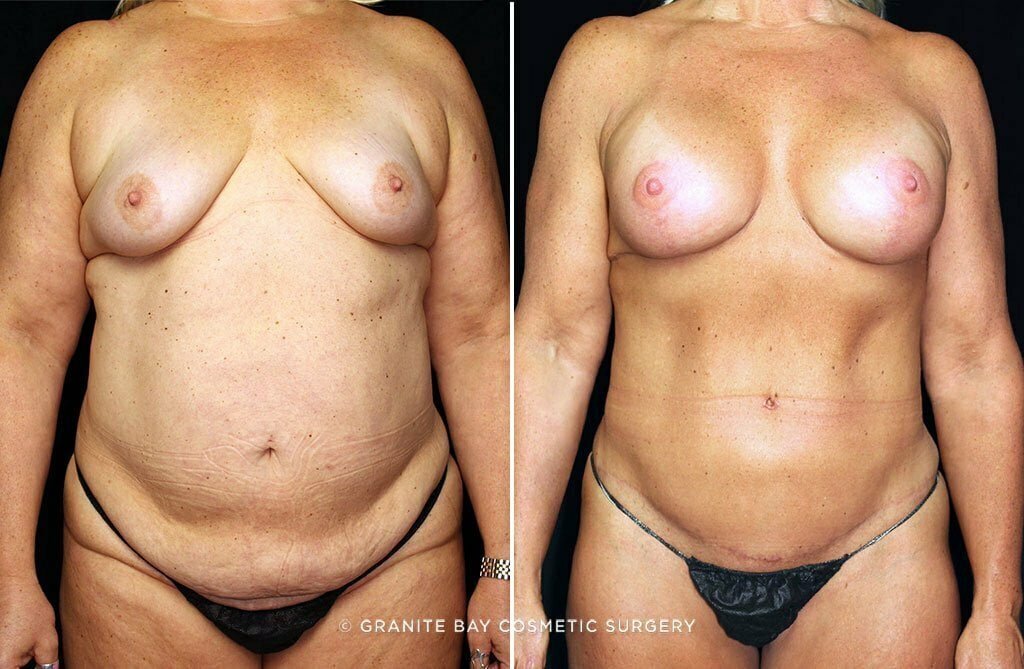 Case # 45 after photo