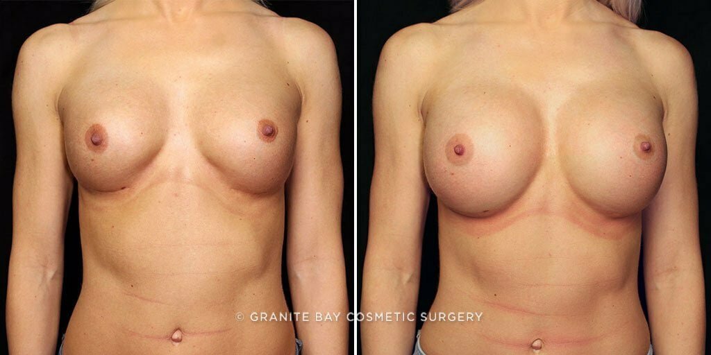 Case # 53 after photo