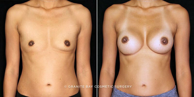 Case # 85 after photo