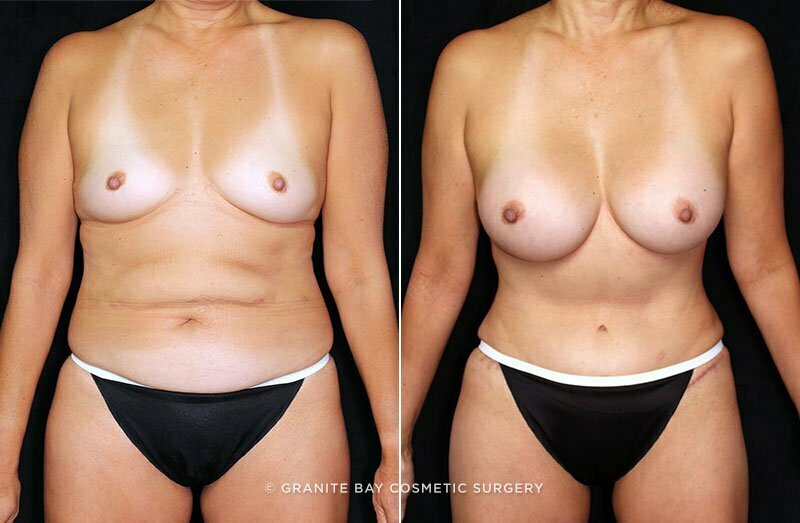 Case # 49 after photo