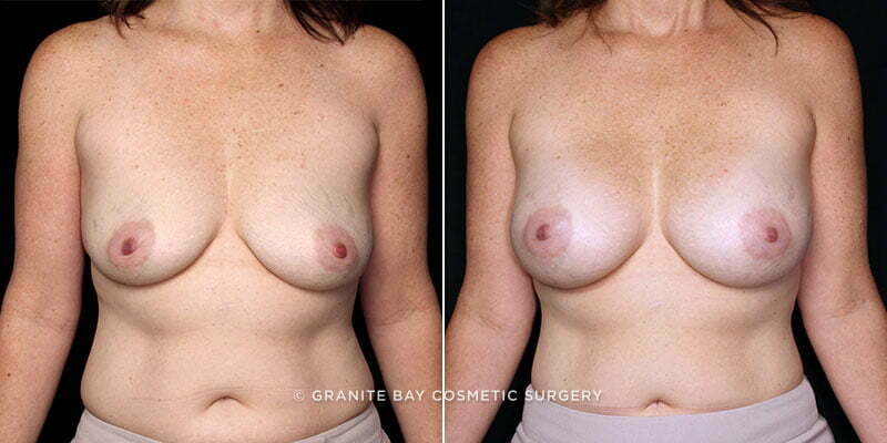 Case # 91 after photo